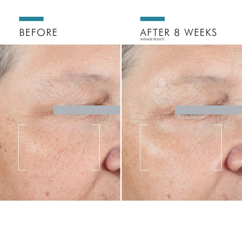 Visible reduction in under-eye wrinkles, puffiness, and dark circles after using SkinCeuticals A.G.E. Advanced Eye—firmer, smoother, and refreshed eye area.