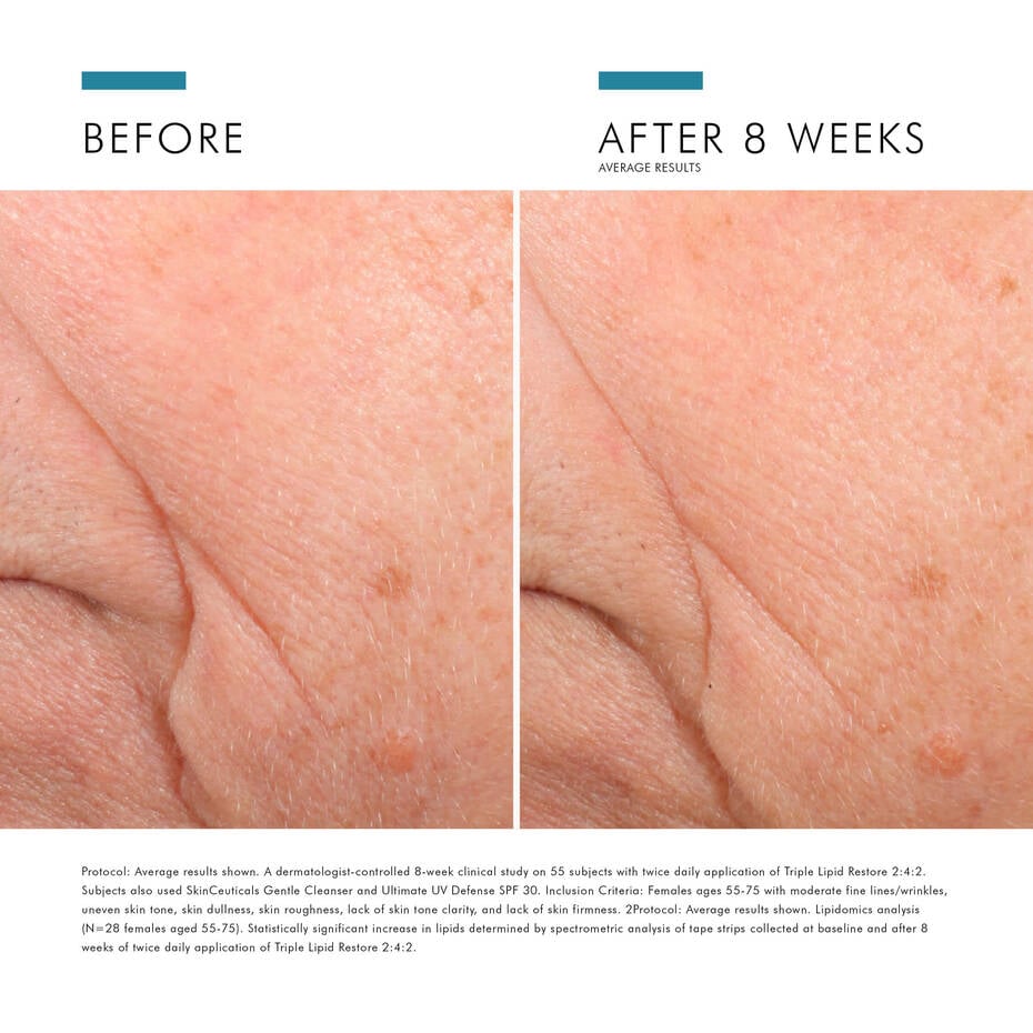 Visible results of using SkinCeuticals Triple Lipid Restore 2:4:2: improved hydration, smoother fine lines, and enhanced skin texture in 8 weeks.