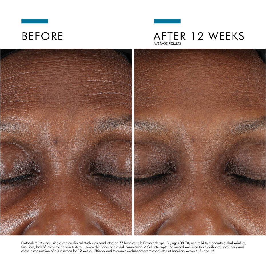 Visible improvement in skin texture and firmness after using SkinCeuticals A.G.E. Interrupter Advanced—reduced wrinkles, plumper skin, and restored radiance.