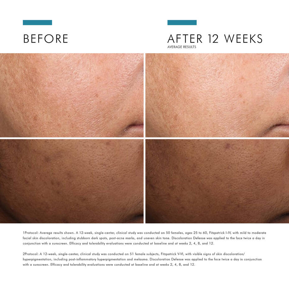 SkinCeuticals Discoloration Defense – lightweight serum for dark spots, hyperpigmentation, and uneven skin tone. Clinically proven results. Available in Canada, including Mississauga